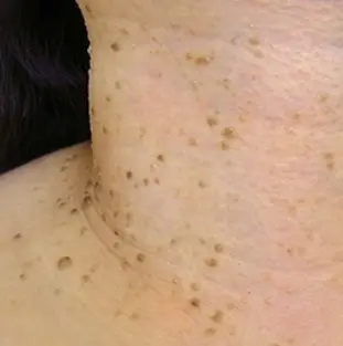 집에서 떼어내는 것보다는 치료가 쉽습니다