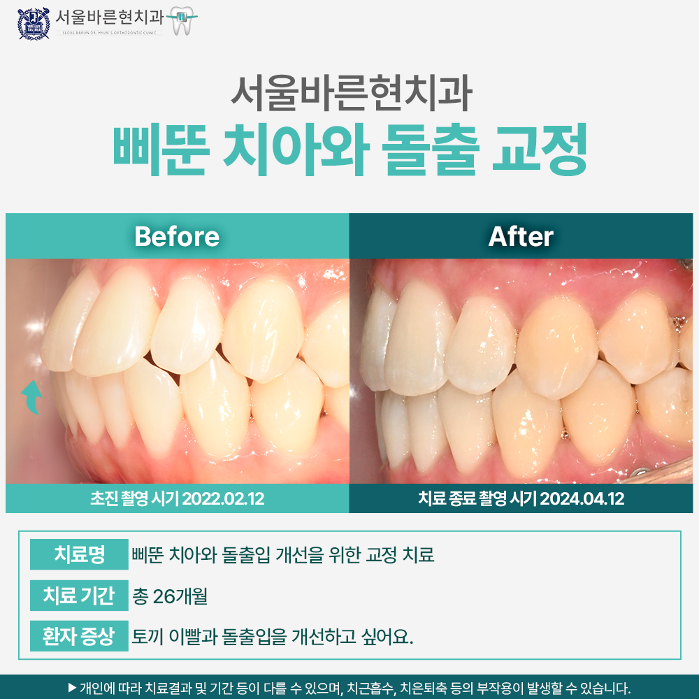 마린시티 치아교정