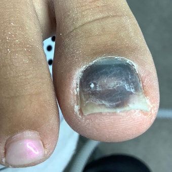 발톱 색 변색의 5가지 주요 원인