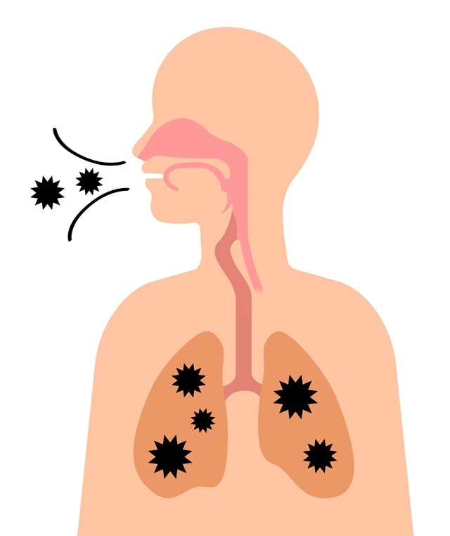 마이코플라스마 폐렴