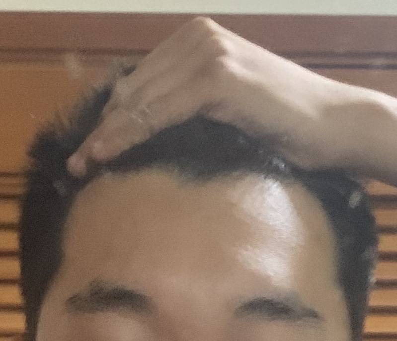 M자 탈모 초기 이마 사진