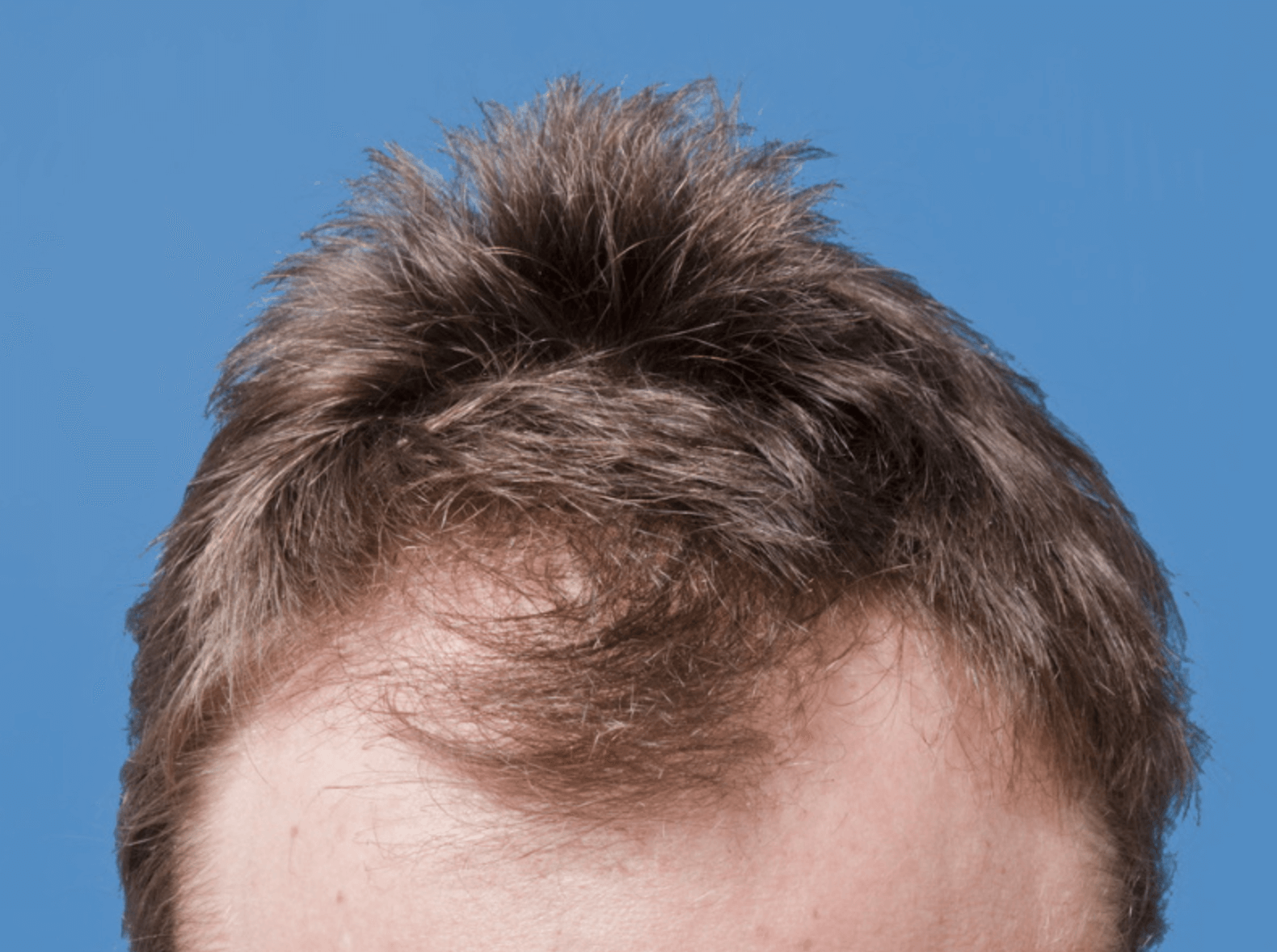 정수리 탈모 원인