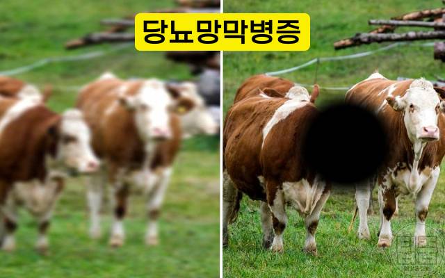 실명 전조증상 당뇨망막병증