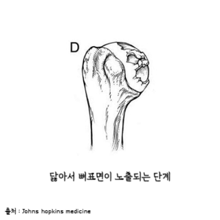 어깨통증원인