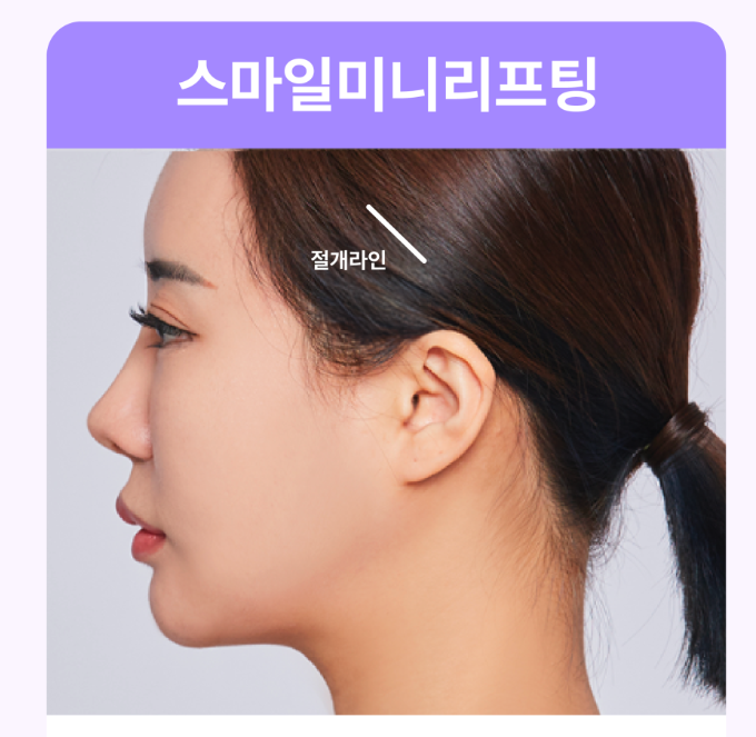 스마일리프팅후기 강남리프팅피부과