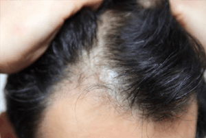 탈모에 좋은 음식03