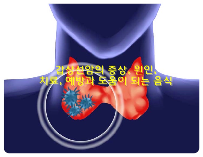 갑상선암의 증상, 원인, 치료, 예방과 도움이 되는 음식