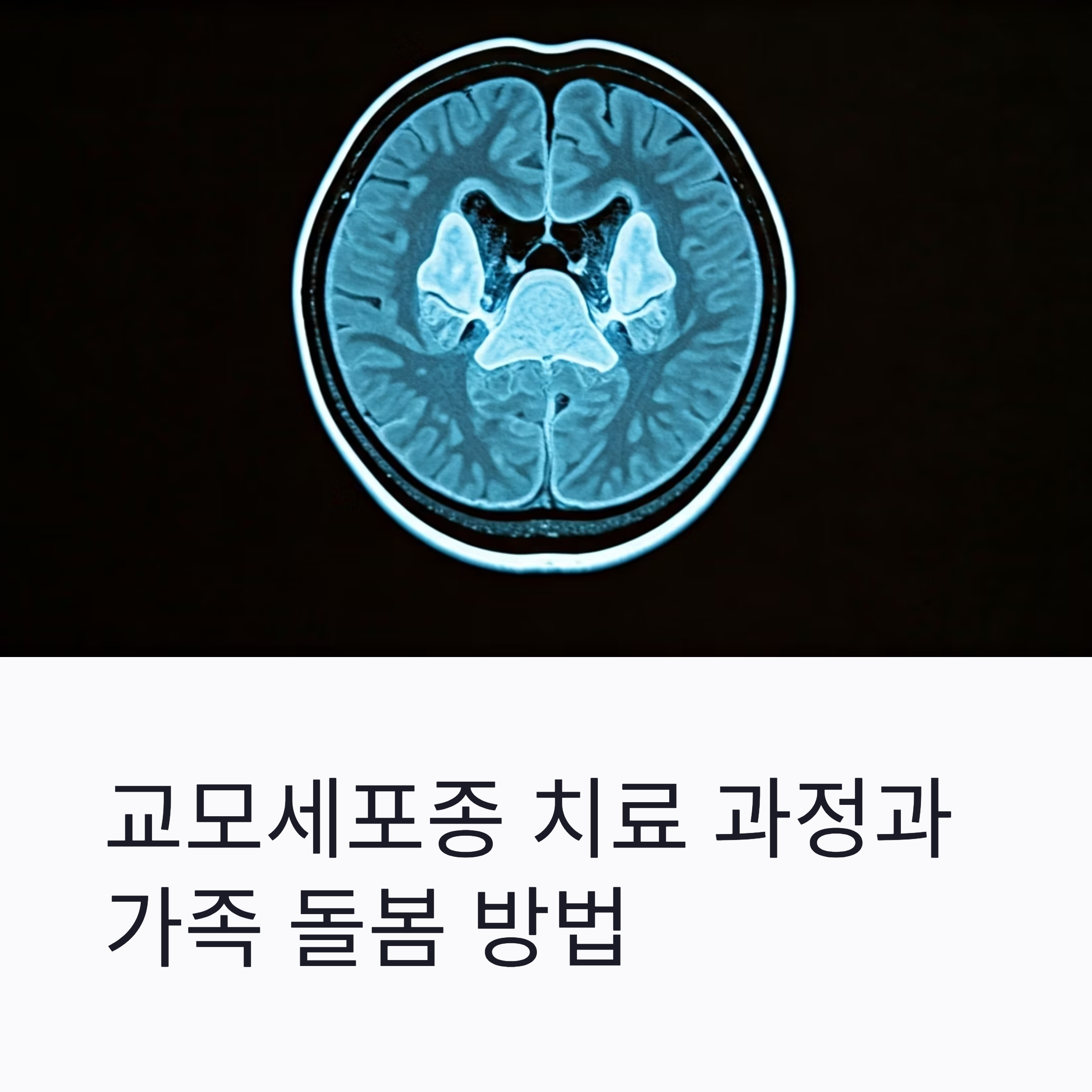 교모세포종 치료 과정 대표이미지