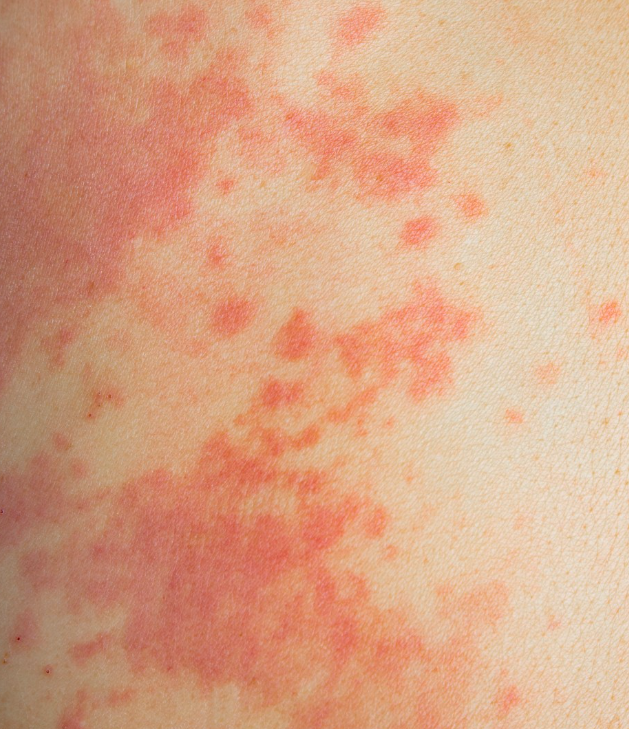 아토피 피부염의 모든 것