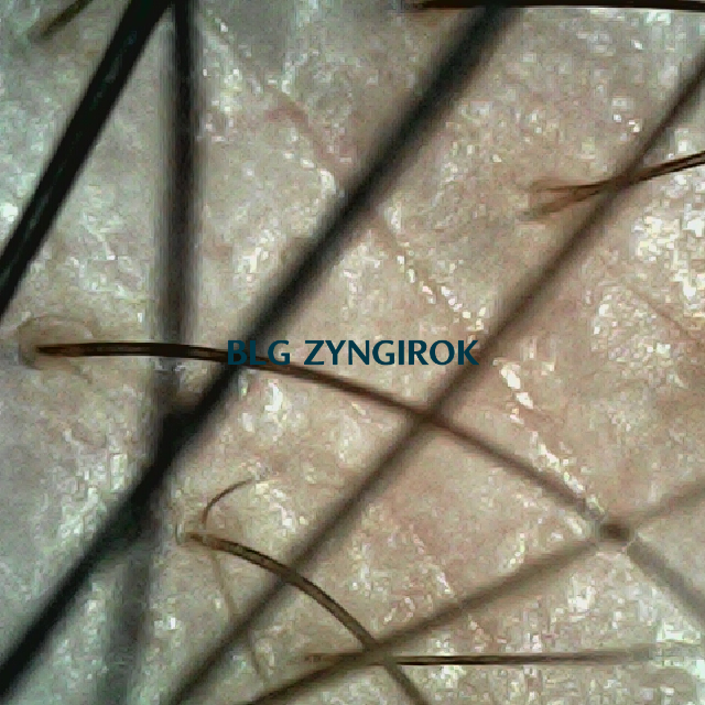 피나모아 복용 18주차 - 오른쪽 M자 부위 두피 모습이다.