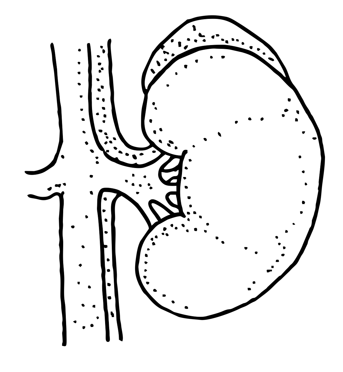 요로결석 위치, 제거 방법, 유전 연관성