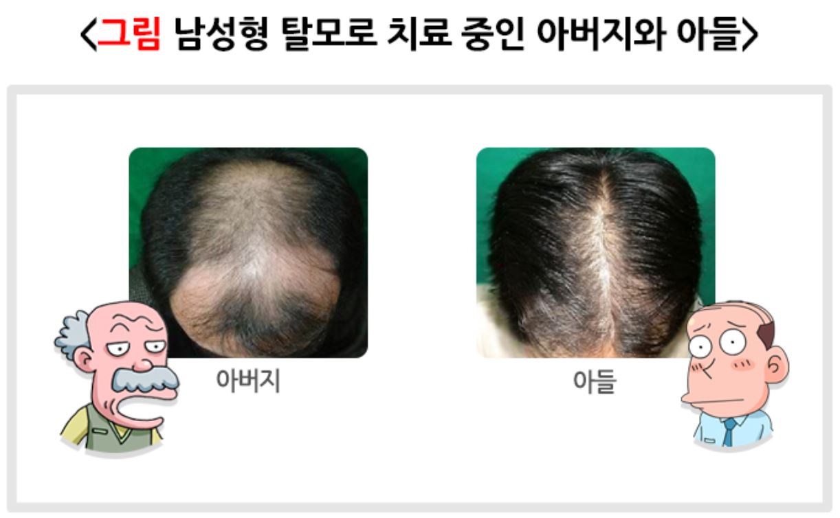남성형-탈모로-치료중인-아버지와-아들의-탈모된-머리를-찍은-사진