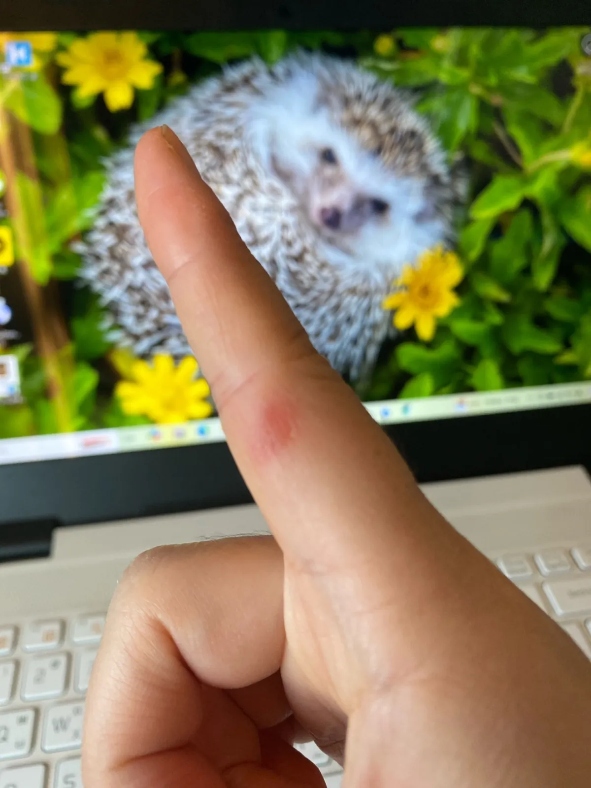 물집잡힌-손가락