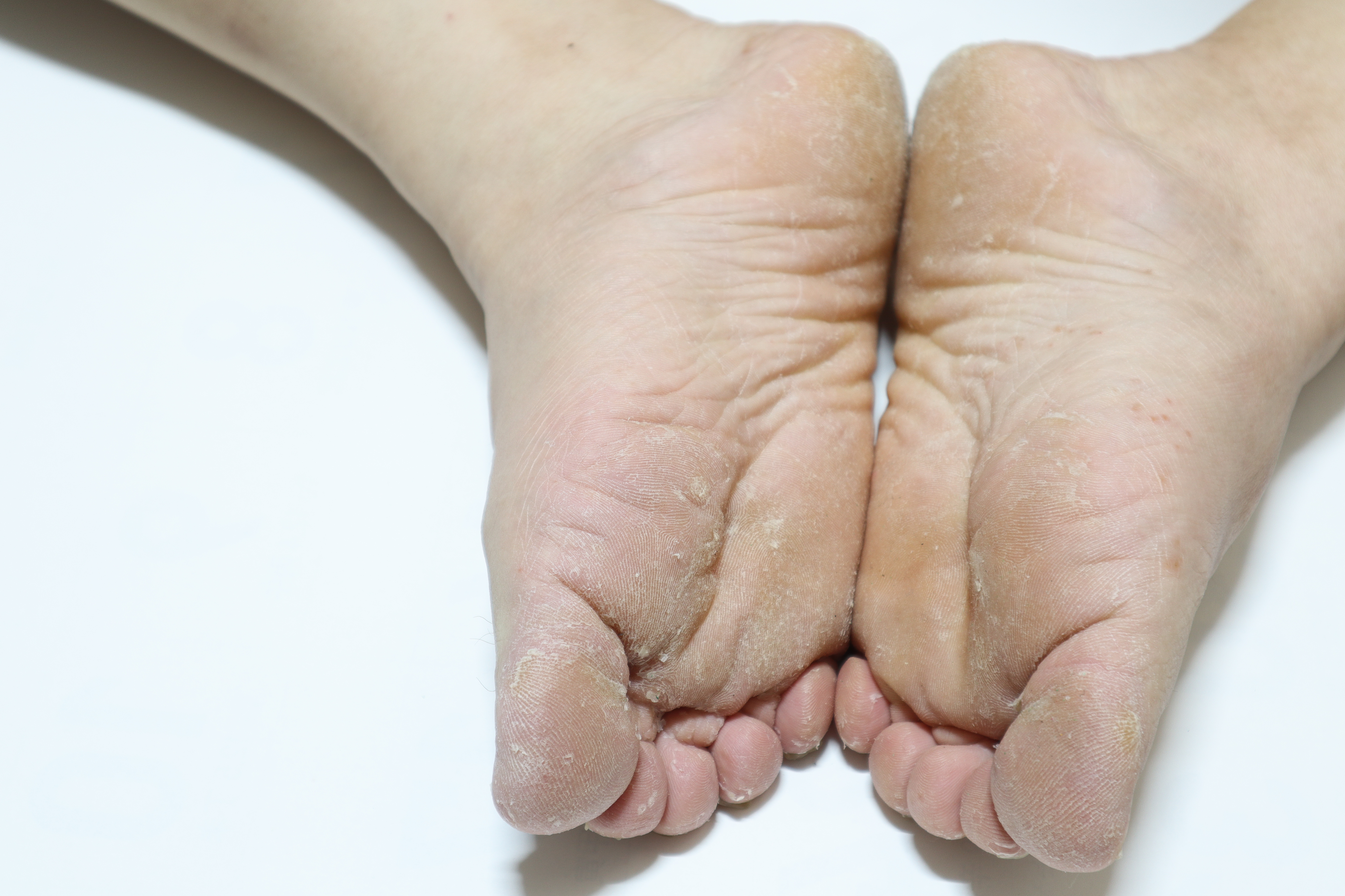 무좀이 있는 환자의 발바닥으로 피부가 벗겨지고, 물집이 있으며, 피부 각질과 피부 경화가 있는 것을 찍은 사진