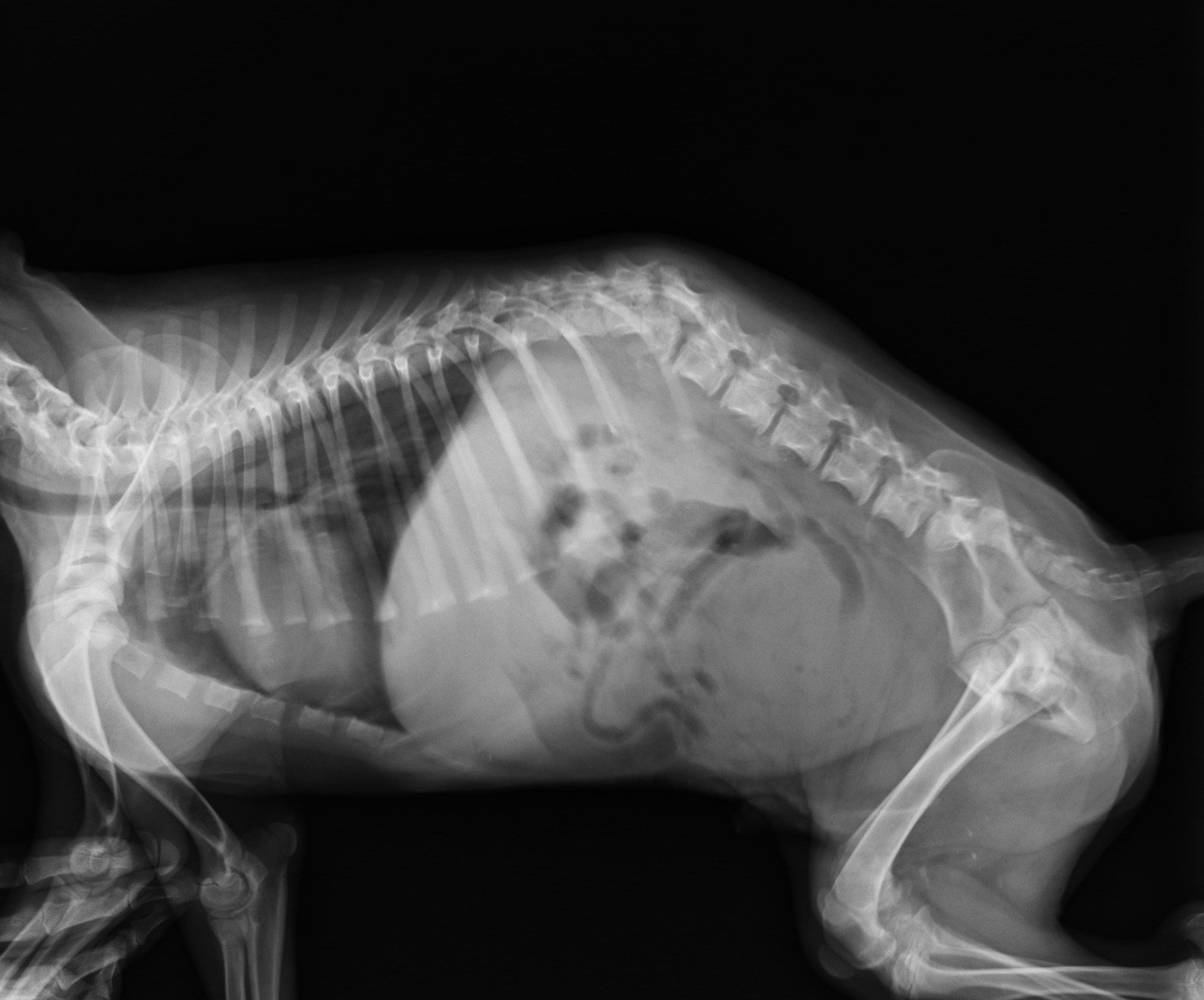 척추 압박 골절 (Vertebral Compression Fracture) – 원인, 증상 및 치료