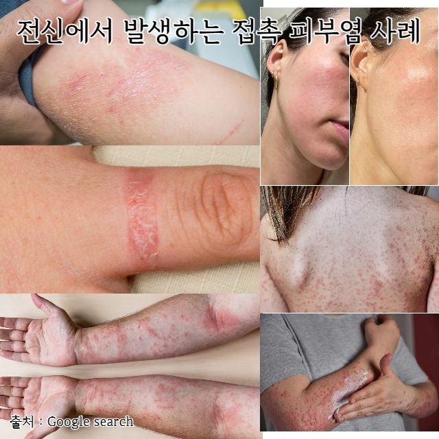 접촉피부염