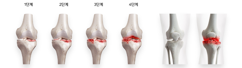 관절 건강 변화