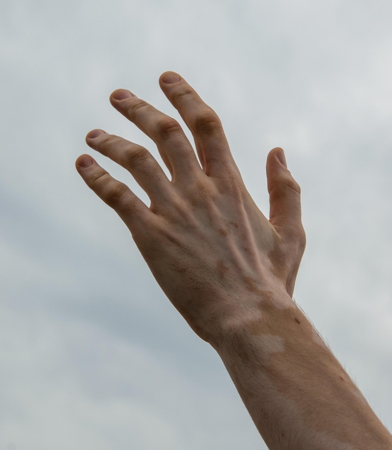 백반증 피부질환 손 모양