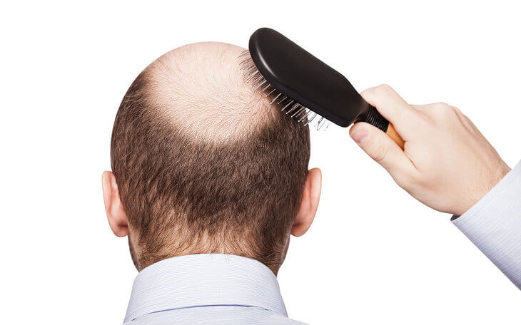 모발이식 3000모 비용