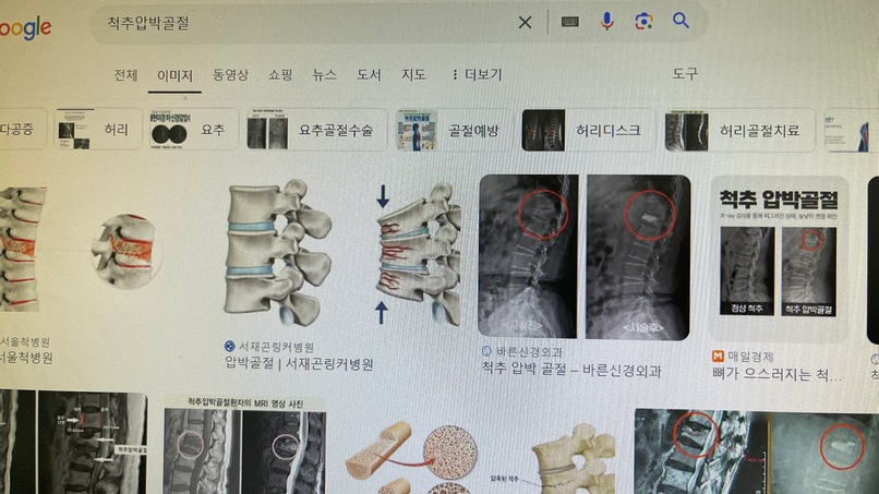 척추압박골절 검색 결과