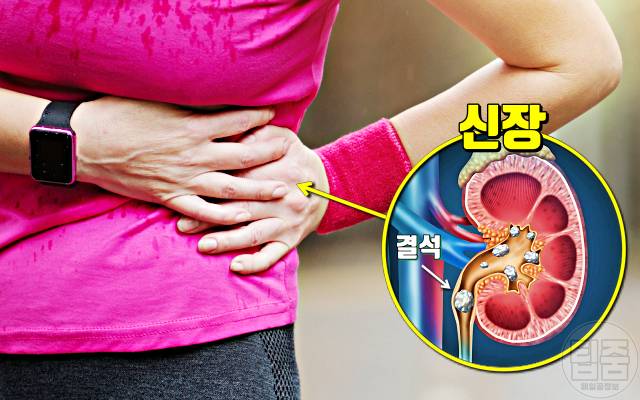 오렌지 매일 먹으면 오렌지효능 신장결석