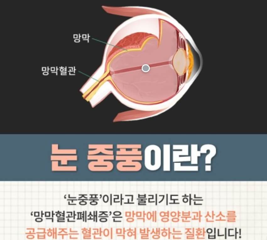 눈 중풍