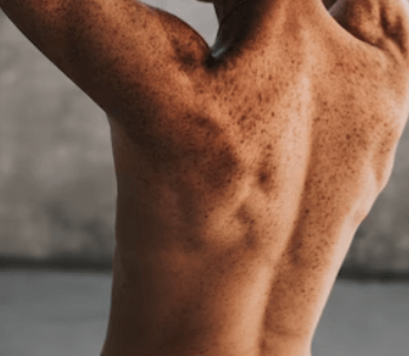 모공각화증 치료방법 - 피부 보습