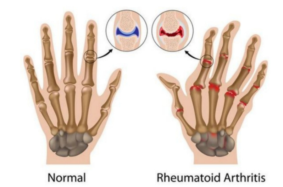 정상적인 손의 뼈와 관절의 상태와 류마티스관절염이 있는 변형된 손의 뼈와 관절의 상태를 이미지화한 사진