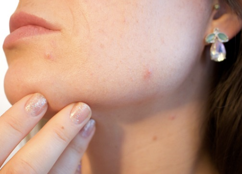 검버섯-없애는-민간요법