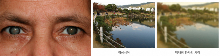 백내장