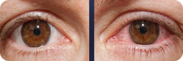 안구-건조증-증상