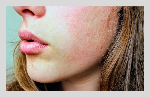 히알루론산 부작용