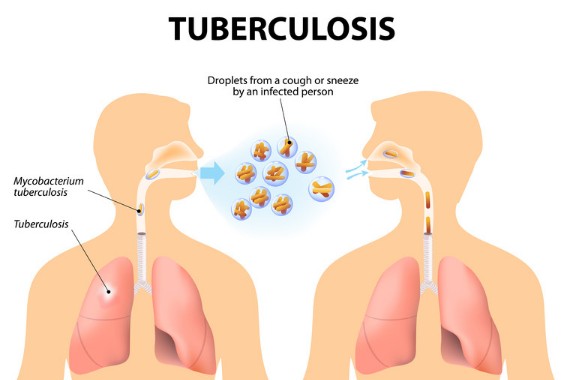 결핵 증상, 결핵원인, 결핵검사, 결핵전염, 결핵치료