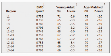 골다공증 수치보는법