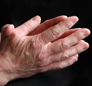 통풍 초기증상 원인 치료법 예방 가이드 총정리