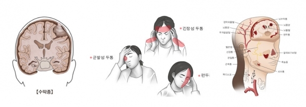 긴장성두통의 원인과 치료