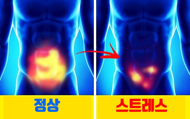 심한 스트레스 증상, 두드러기, 피부, 건강 팁줌 매일꿀정보