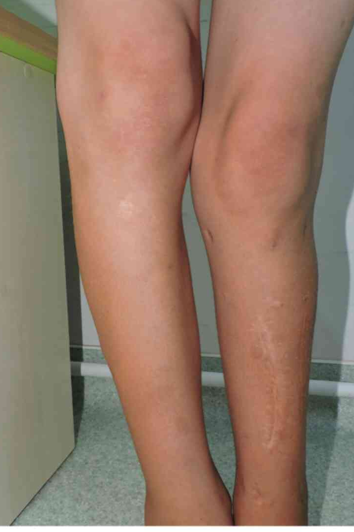 신경섬유종 초기 증상&amp;#44; 혹시 나도? 놓치면 안 되는 신호