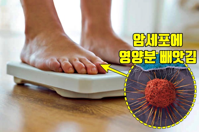 체중감소 자궁암 증상 원인,자궁경부암,자궁경부암초기증상