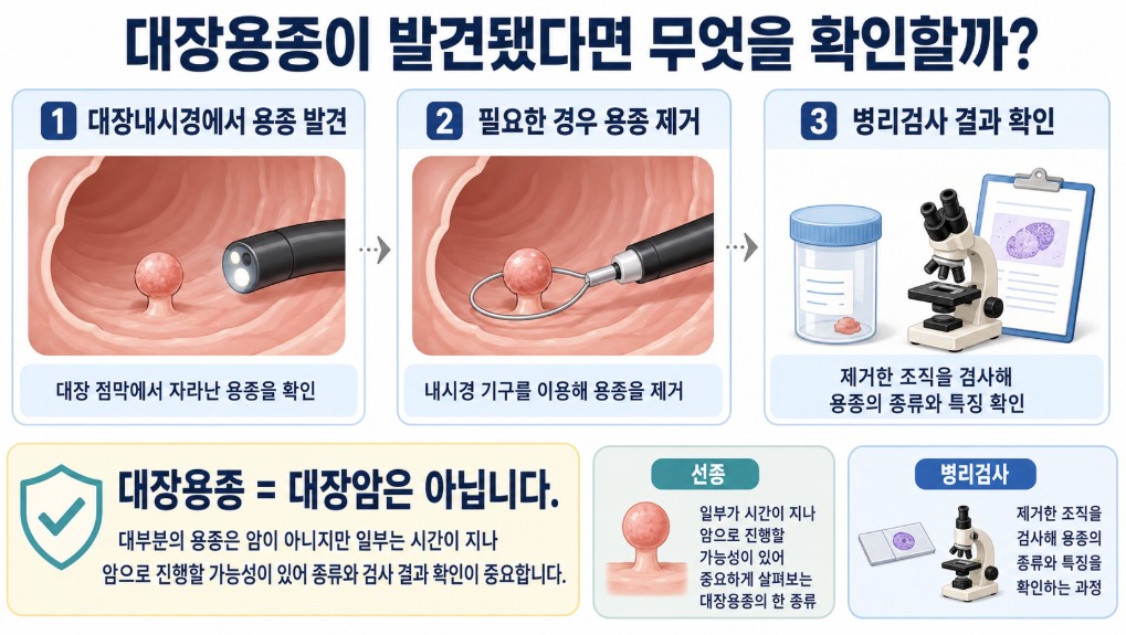 대장내시경에서 대장용종을 발견하고 제거한 뒤 병리검사로 확인하는 과정을 설명한 이미지