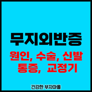 무지외반증(Hallux valgus)