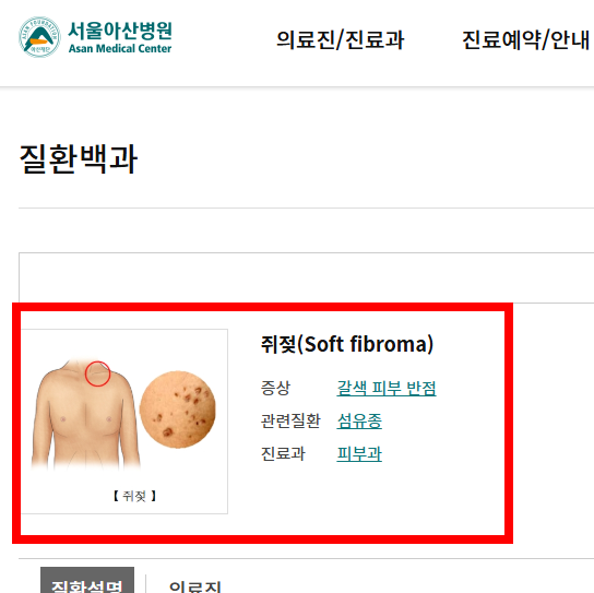 쥐젖 제거방법 알아보기
