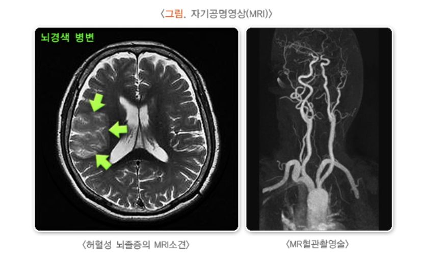 MRI