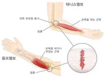 팔꿈치 통증 원인 6가지증상운동법예방법치료법까지_10
