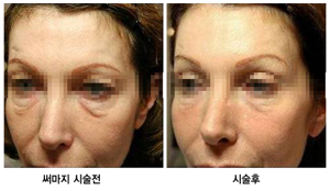 대구 써마지
