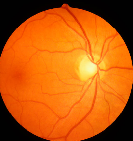 비문증 치료방법, 자연치유, 원인 총정리 (2024ver)