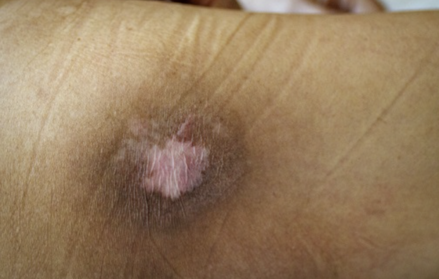 당뇨병 환자의 욕창 — 상처가 잘 낫지 않는 이유