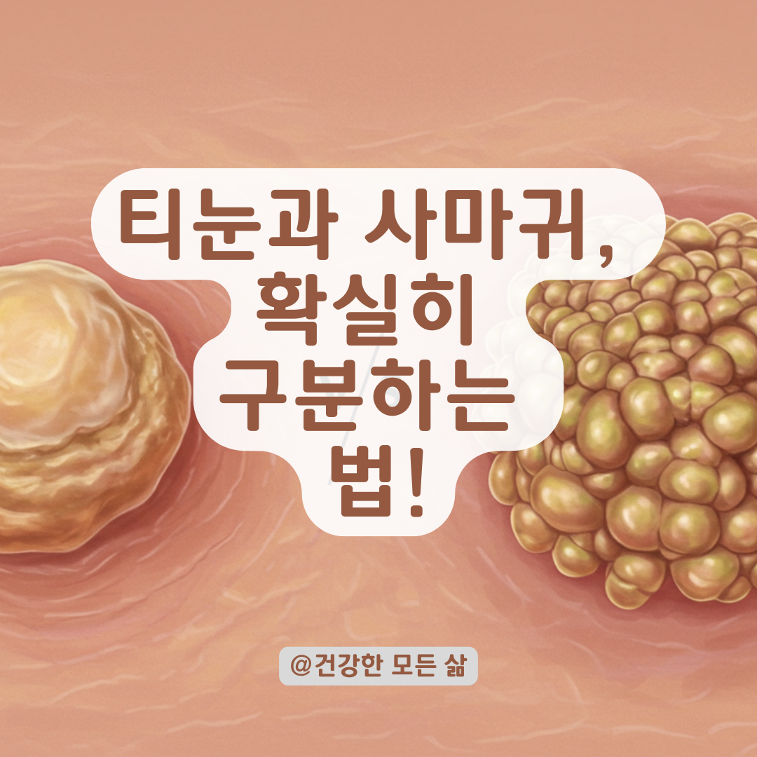 피부과 전문의가 알려주는 티눈 vs 사마귀 정확히 구분하는 법.