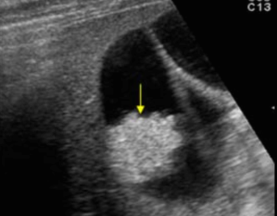 선종성 용종 (adenomatous polyp)