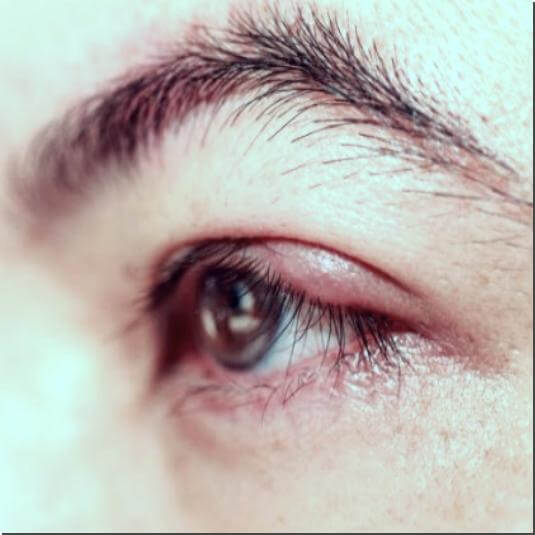 다래끼 원인과 자주 나는 이유